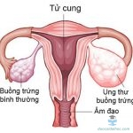Những triệu chứng sớm của ung thư buồng trứng ở phụ nữ